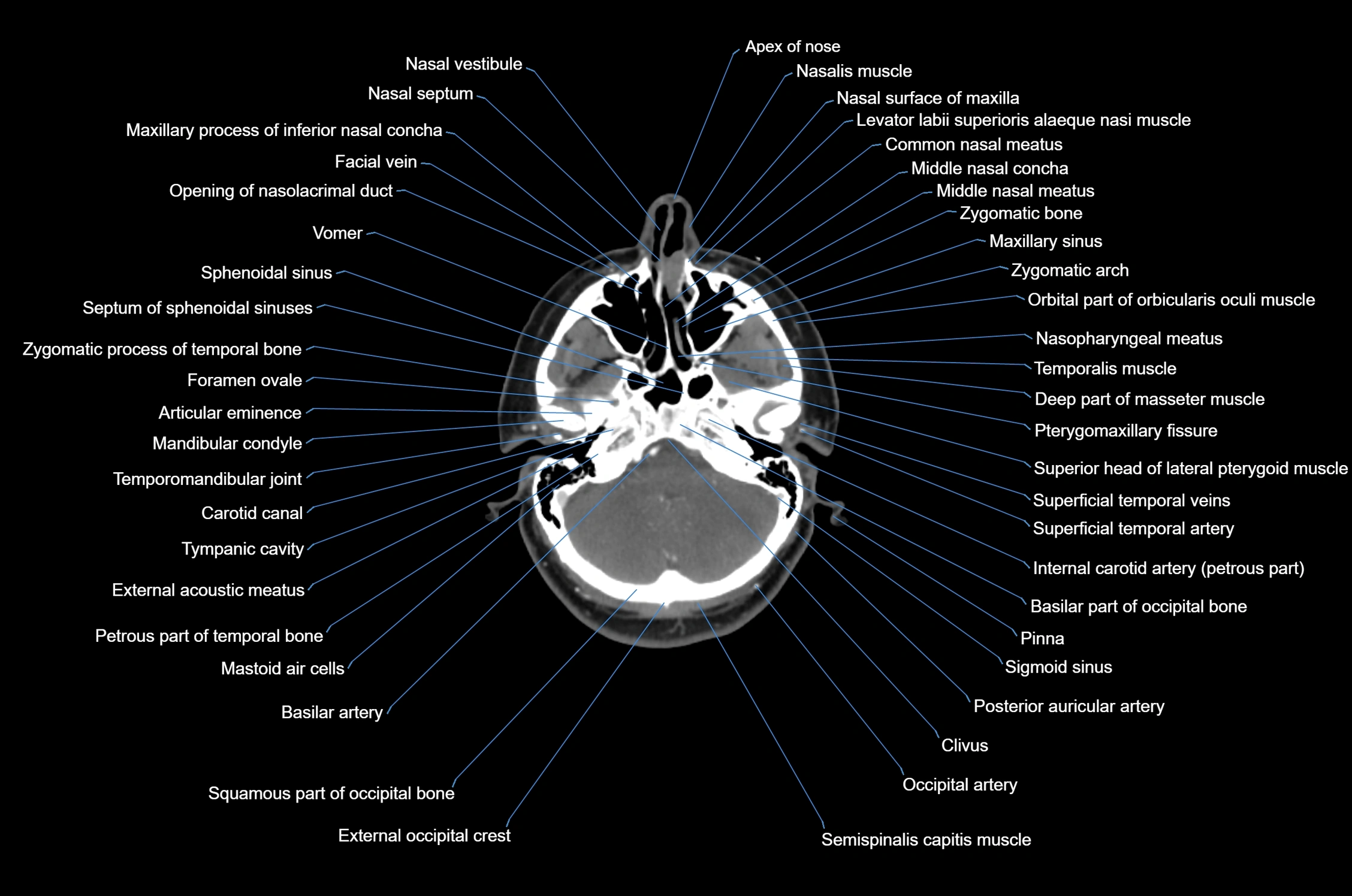 CT Neck axial cross sectional anatomy radiology image-img-00001-00014.webp